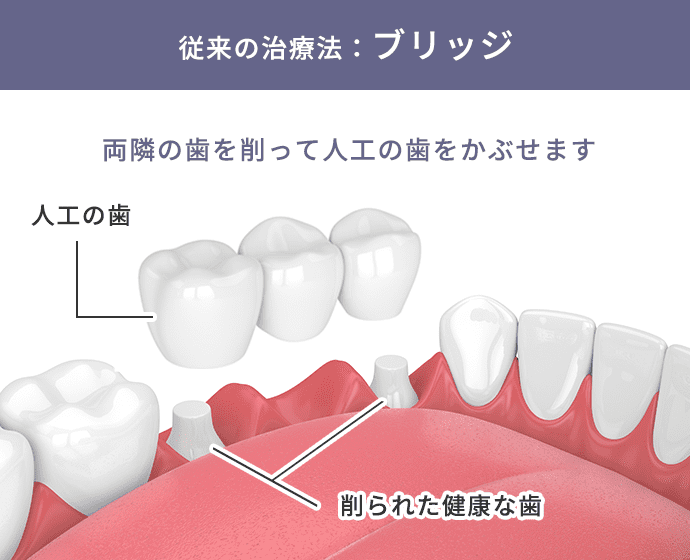 従来の治療法：ブリッジ