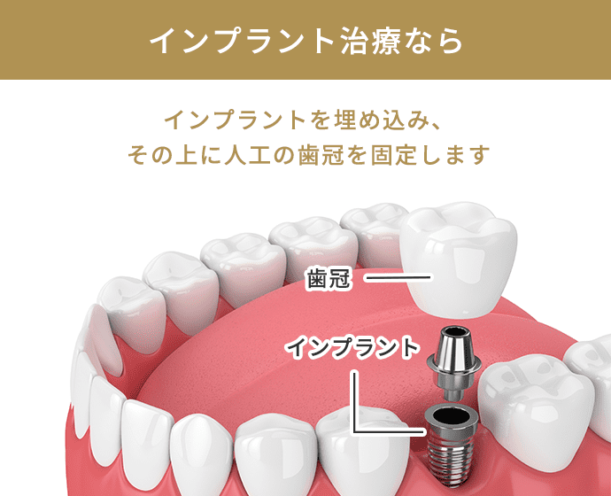 インプラント治療なら