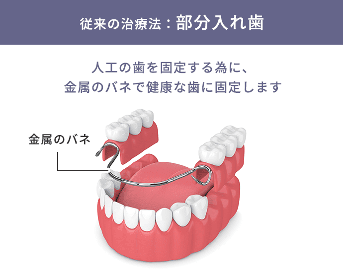 従来の治療法：部分入れ歯