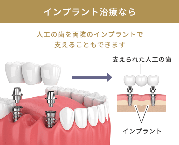 インプラント治療なら