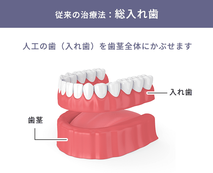 従来の治療法：総入れ歯